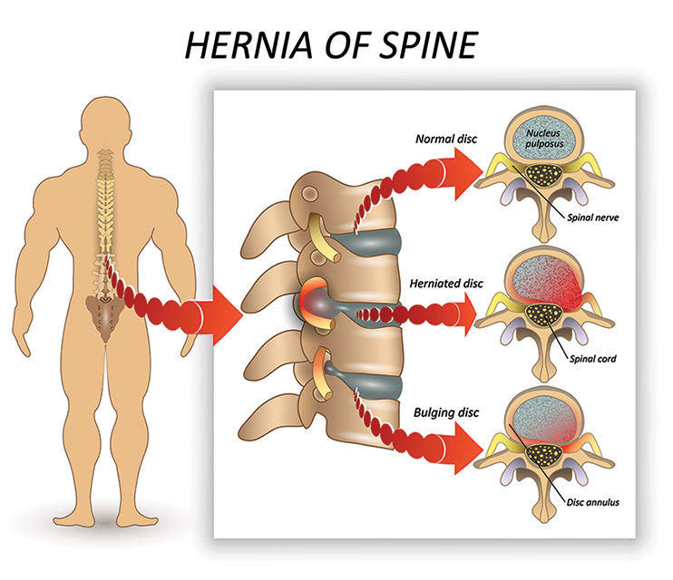 Hernia of the Spine